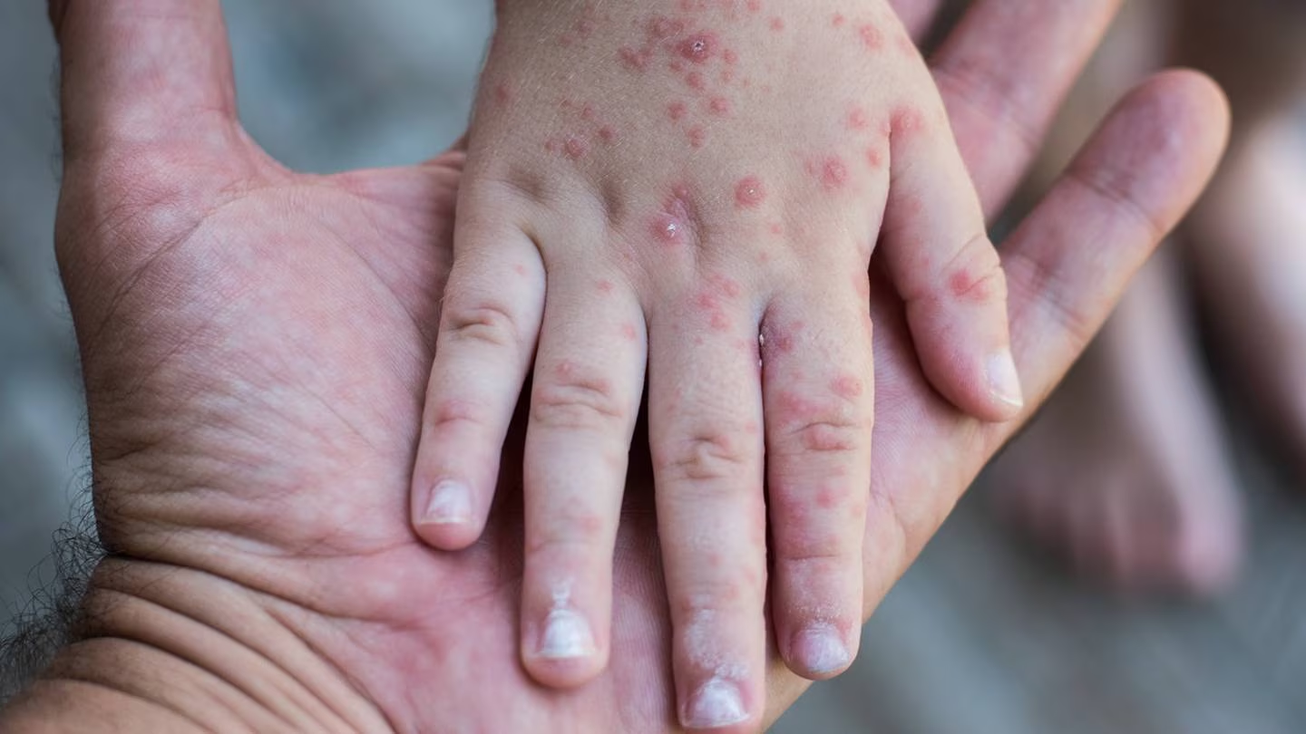 Reportan brote de Coxsackie en Oaxaca; pobladores acusan contaminación en río local