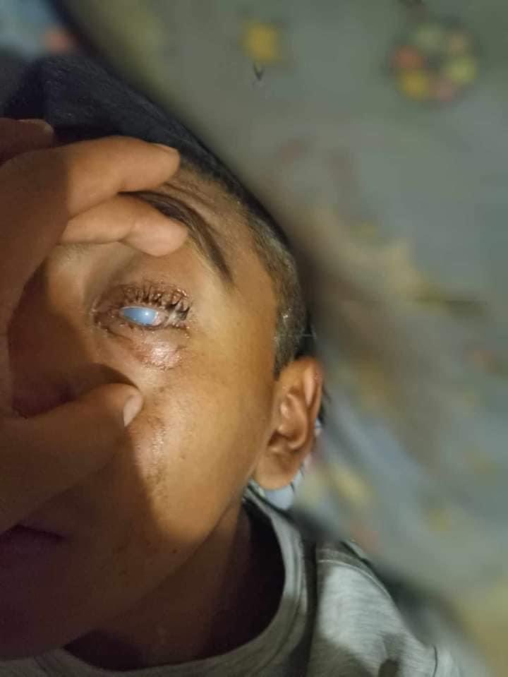 Niño de 13 años pierde 90% de visión tras ser víctima de bullying en Oaxaca